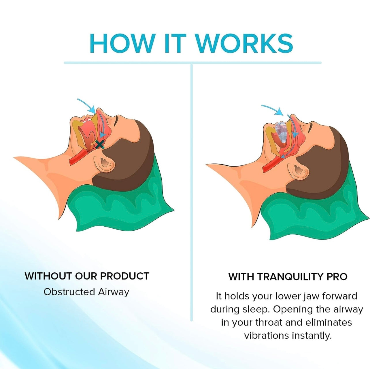 Anti Snoring Mouthpiece